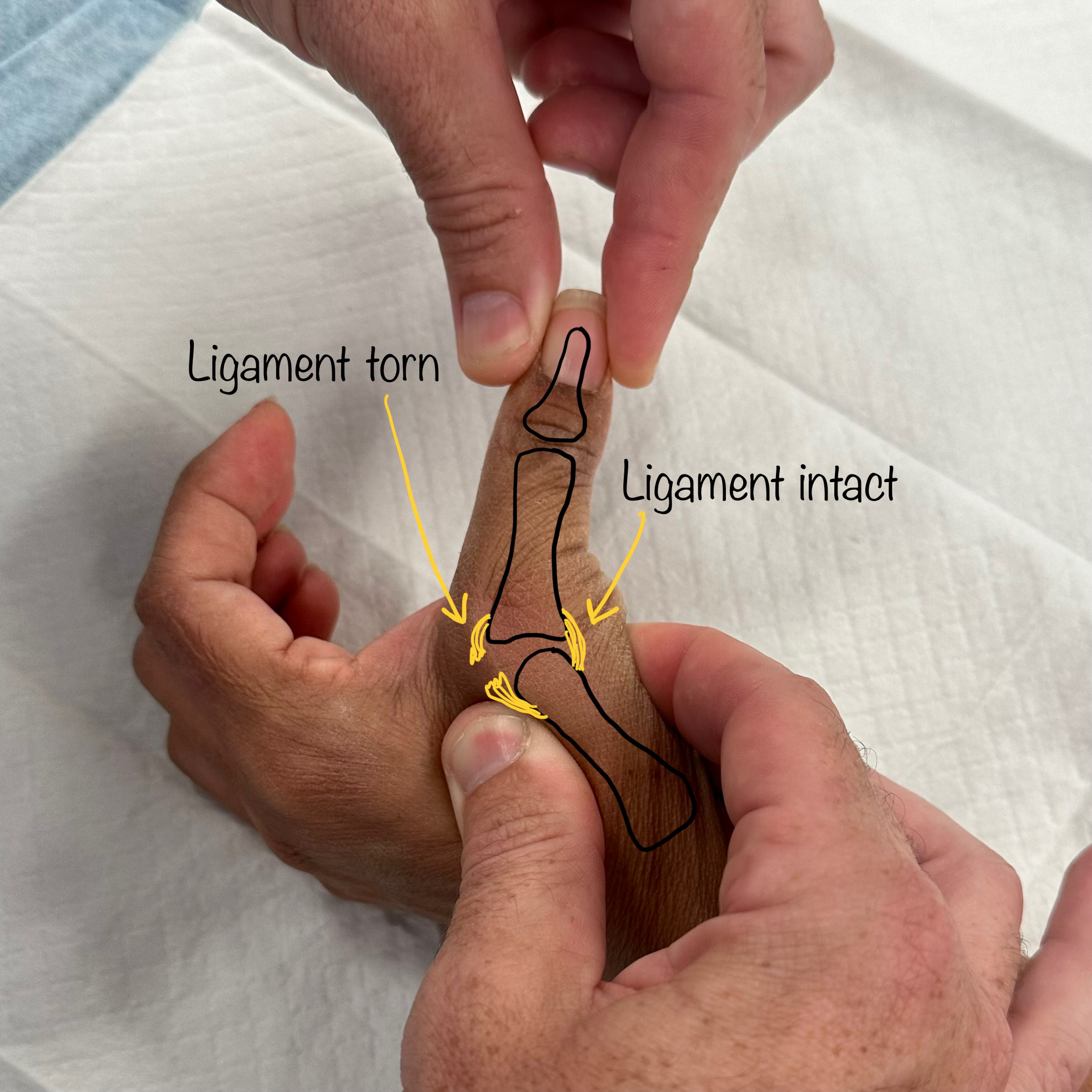 Thumb Ulnar Collateral Ligament UCL Repair Dr Oscar Brumby Rendell