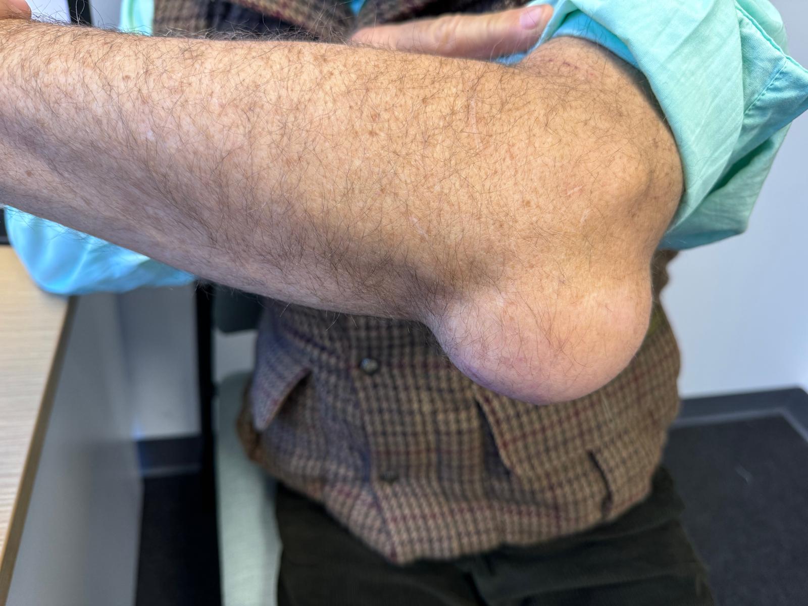 bpc 157 elbow bursitis Bursitis