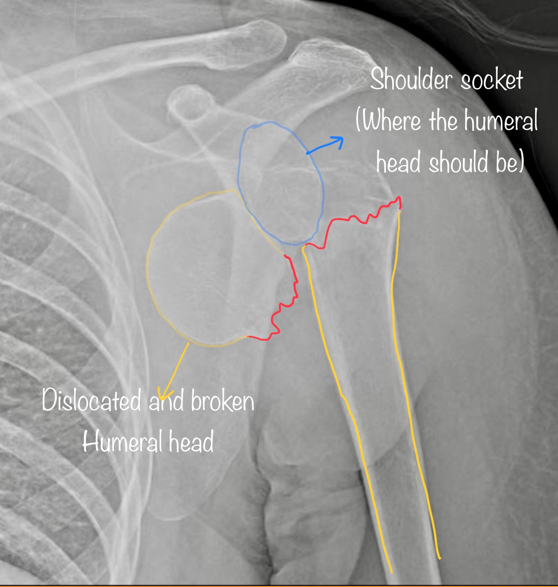 Proximal Humerus Fractures Dr Oscar Brumby Rendell Adelaide