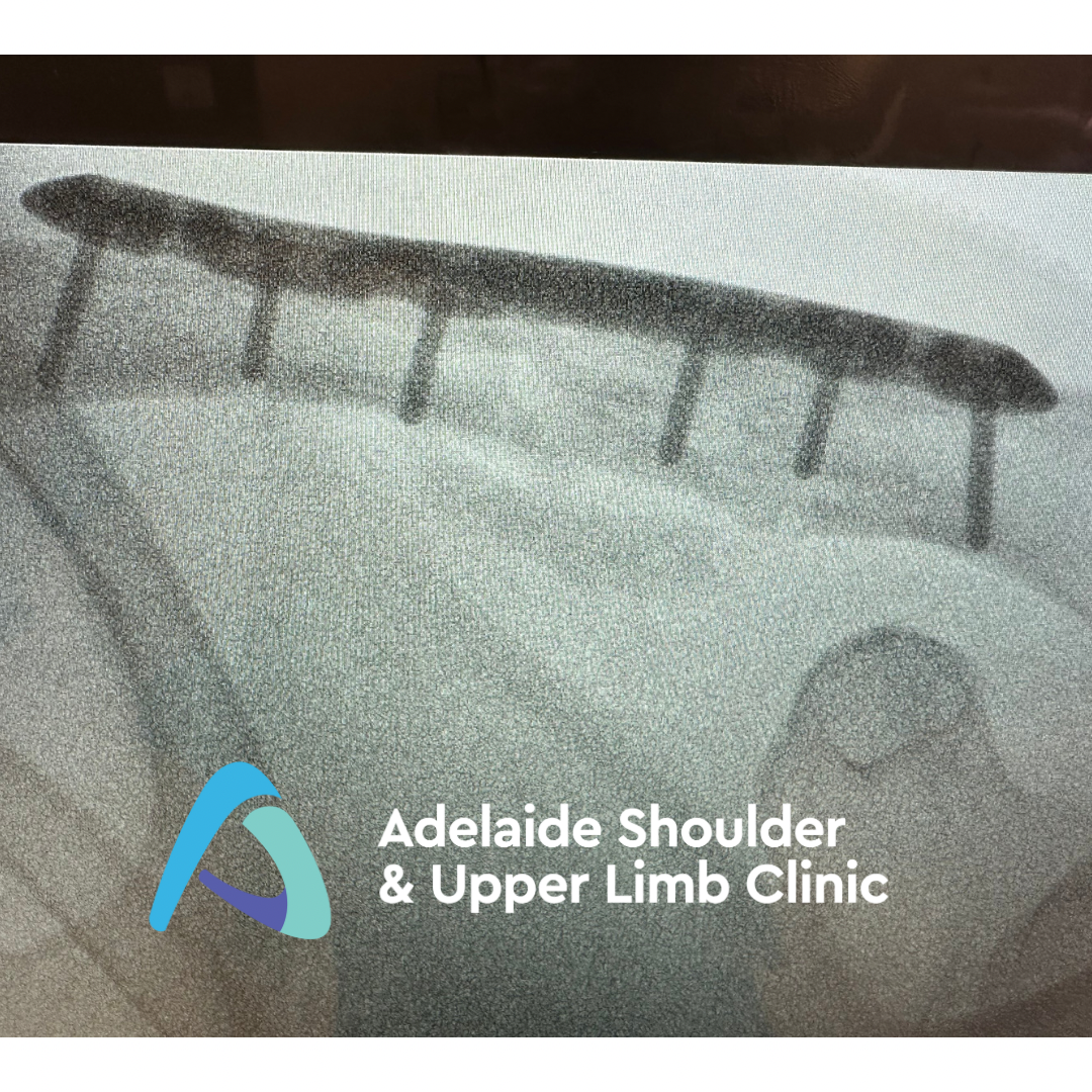 Clavicle Fracture | Dr Oscar Brumby-Rendell | ASULC | Adelaide Shoulder & Upper Limb Clinic