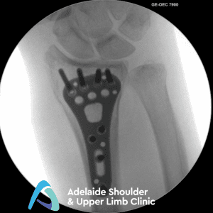 Distal Radius Fracture | Dr Oscar Brumby-Rendell | ASULC | Adelaide Shoulder & Upper Limb Clinic