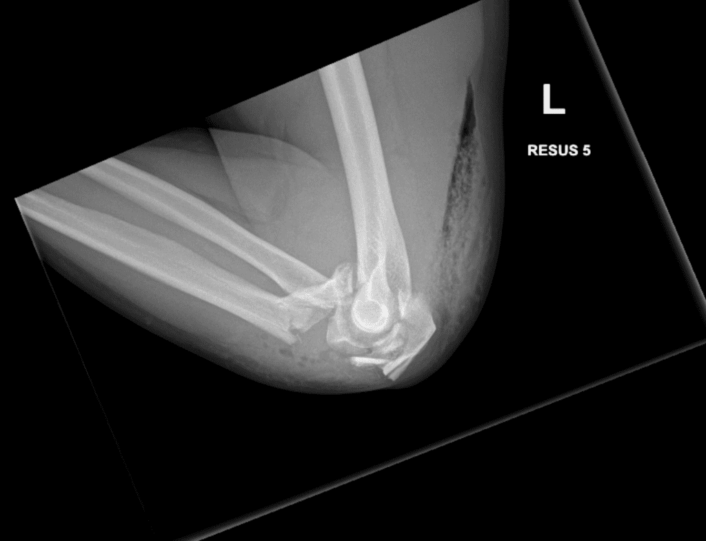 Fractures Around the Elbow Dr Oscar BrumbyRendell Orthopaedic Surgeon