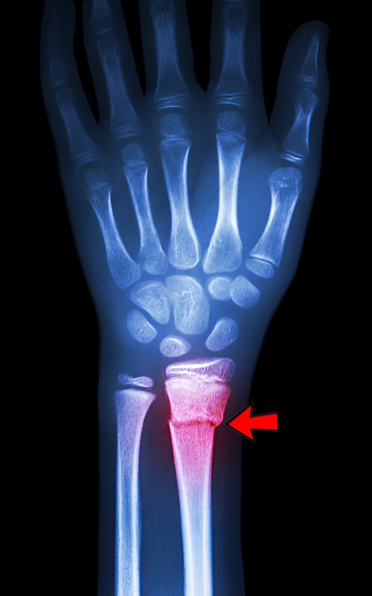 Distal Fracture