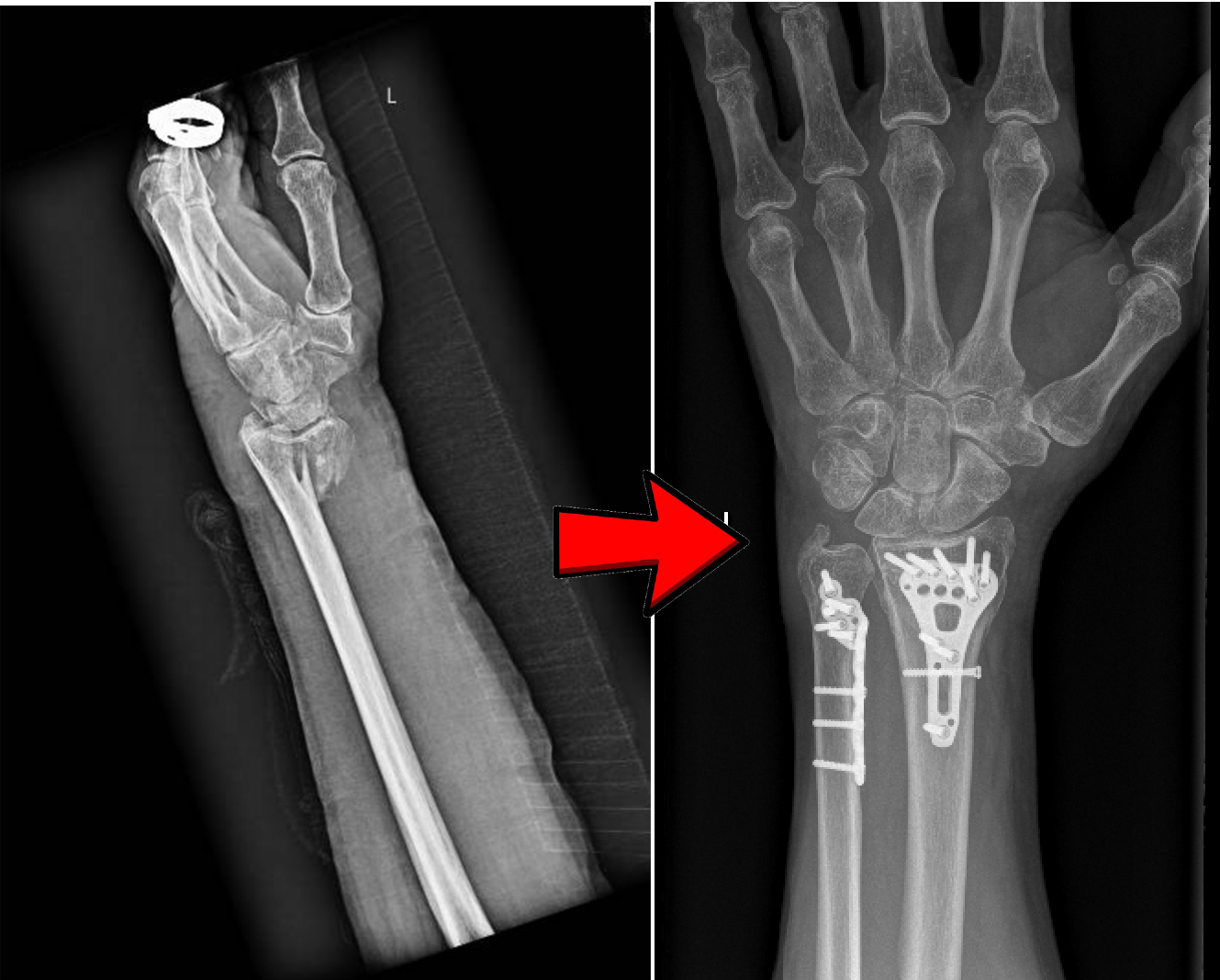 Distal Radius Fracture repair