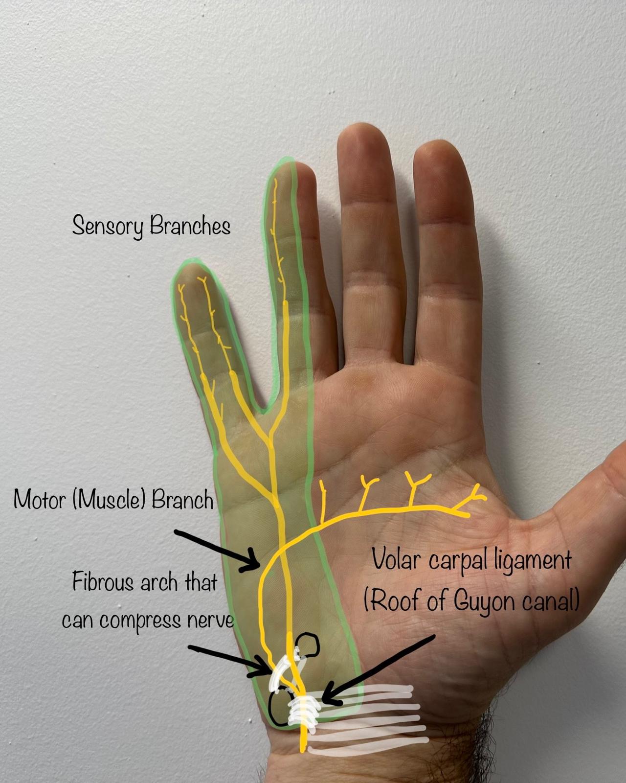 George Guyon Ulnar Nerve Syndrome Nhs